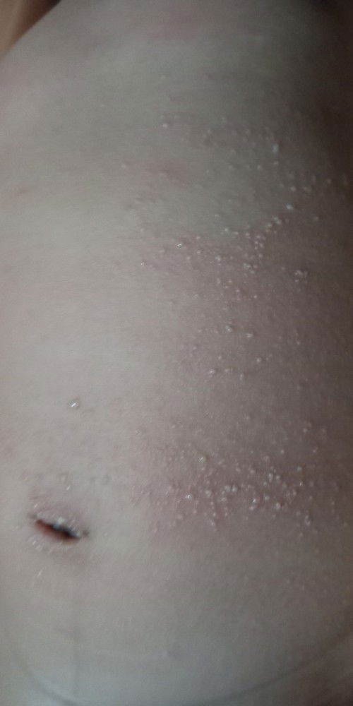 Perut bayi ada bintik merah kasar berisi cairan