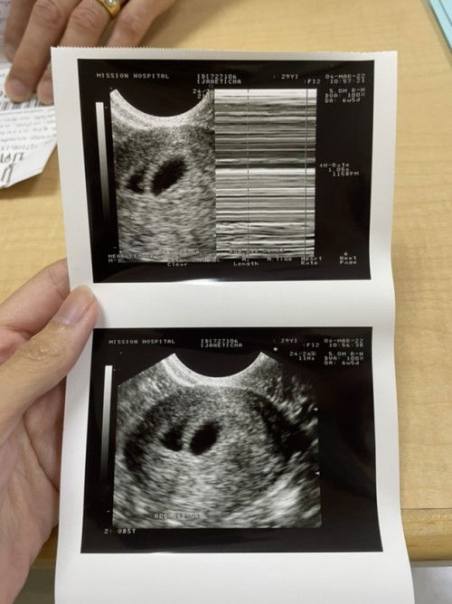 ขอสอบถามแม่ๆที่ตั้งครรภ์แฝดค่ะ