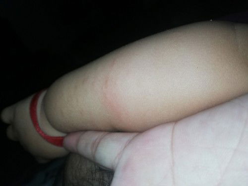 Ask lang po ano po kaya tong nasa balat ng baby ko 9months na