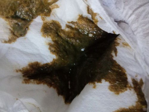 ลูก3เดือนกว่าถ่ายเป็นสีเขียวเข้มไม่เหลวจะเป็นครีมๆจะอันตรายมั้ยหรือปกติของเด็กลูกท่านนมผง