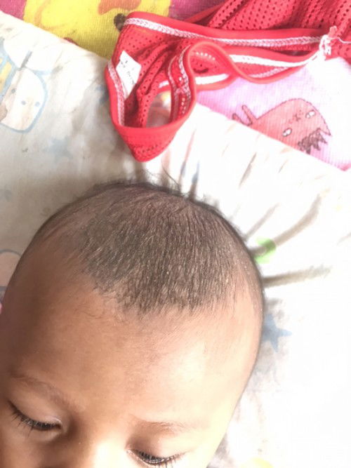 สอบถามแม่ๆค่ะ บนศีรษะน้องอันนี้คืออะไรค่ะ