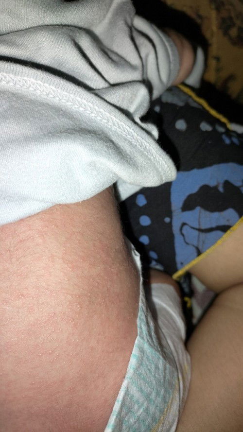 Punggung, lipatan kaki, lipatan tangan, lingkaran perut pada ruam merah itu kenapa ya?