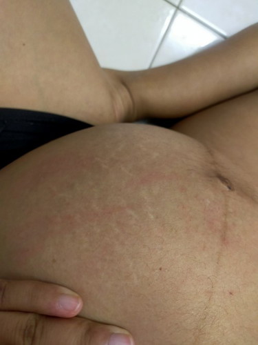 แม่คนไหนมีอาการคันหน้าท้องบ้างคะ