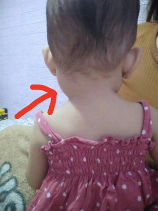 Bukol sa may leeg, medyo likod ng tainga nya , may same case po ba dito sa anak nyo? 1yr.&3mos.old