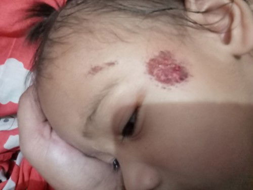 ลูกล้มหน้าไถลเป็นแผลแบบนี้ใช้อะไรทาได้บ้างคะ ตอนนี้แผลเริ่มตกตกสะเก็ดแล้ว