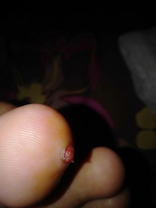 Kutil pada ibu hamil