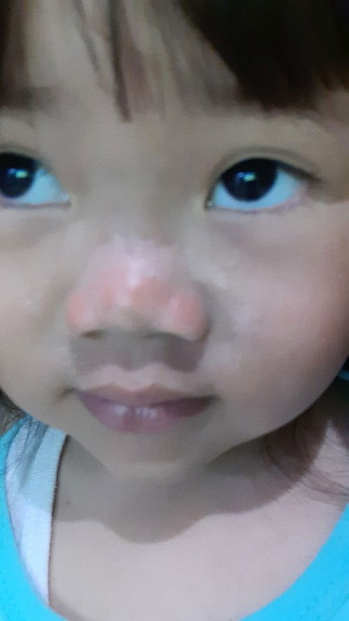 Kulit anak merah trus mengelupas stelah berenang