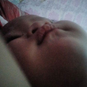 Bibir pecah" dan berdarah