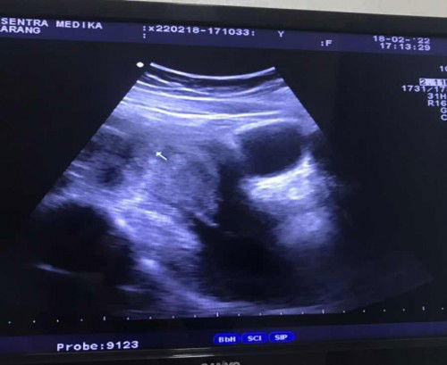 USG 4 weeks penebalan rahim