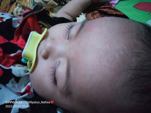 Rain merah di wajah setelah demam