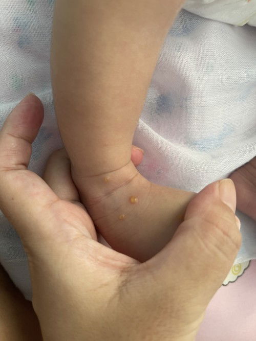 มีตุ่มใส ข้างในเหมือนเป็นน้ำๆ