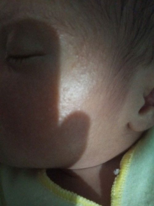 Pipi baby banyak bintil kecil