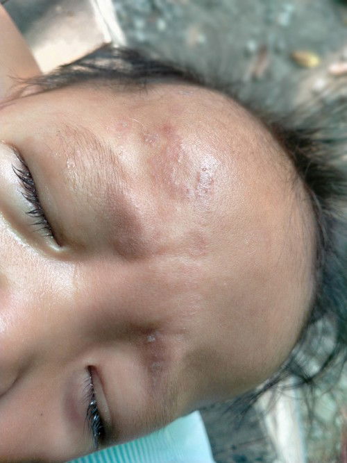 หายาทาแก้แก้แผลกับอก้ยางมะม่วงกัด