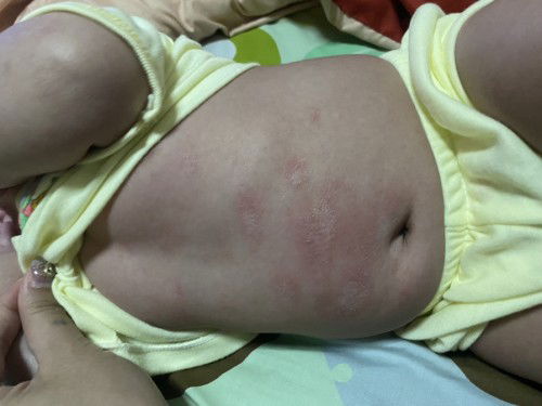 สอบถามแม่ๆบ้านไหน น้องเป็นผื่นแบบนี้บ้างคะ เอาไปหาหมอก็หายมาสักระยะ แล้วเป็นขึ้นอีก เหมือนกลาก เกลื้อน เลย ใช้ยาไรกันบ้างคะ