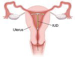 What can you say about IUD?