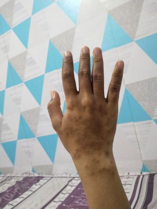 Kulit menghitam saat hamil