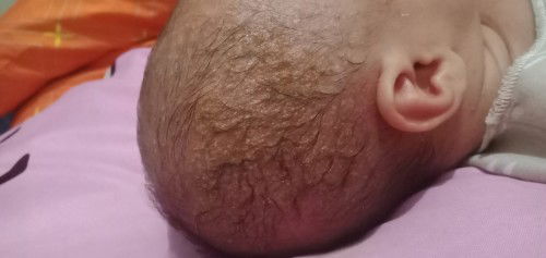 Kepala bayi berkerak