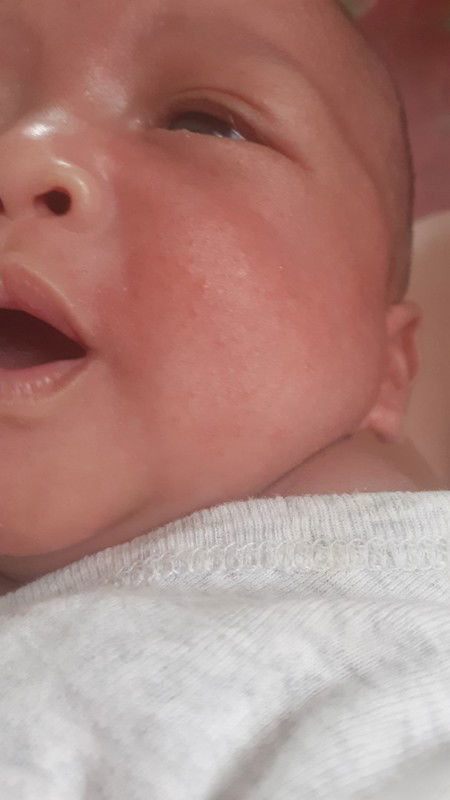 ผื่นแดงๆขึ้นเต็มหน้า