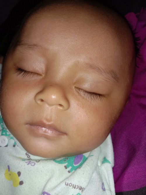 Beruntusan diwajah bayi