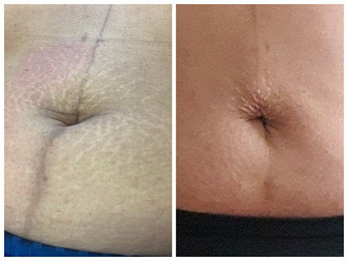 รีวิวสักปรับสีลอยแตกลาย