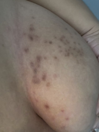 Makati sa ilalim ng breast na nag butlig butlig