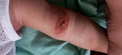 Sugat sa braso ni lo ko :(