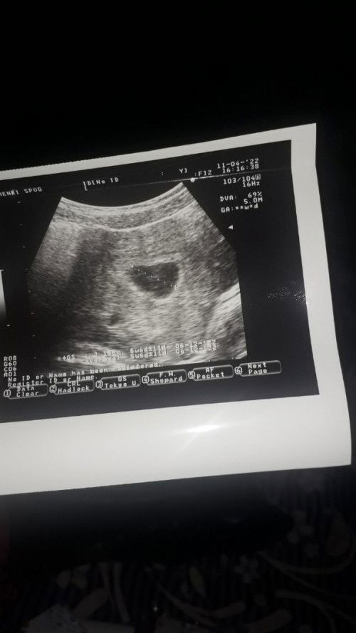 Beda uk hpht dan hasil usg