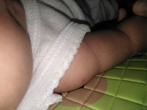 Bekas suntik bcg memerah