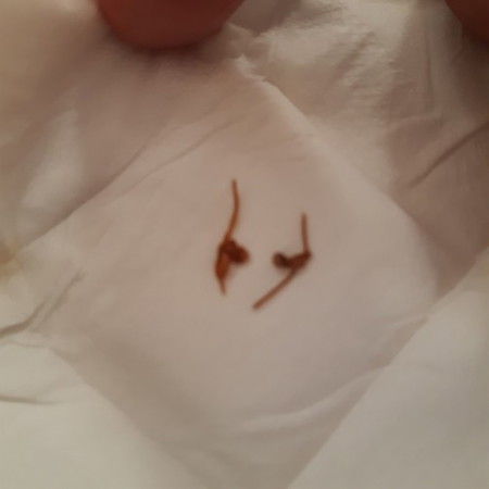 หลังจากคลอดลูกมาได้5วันมีเส้นไหมหลุดออกมาจากช่องคลอดแบบนี้ปกติไหม