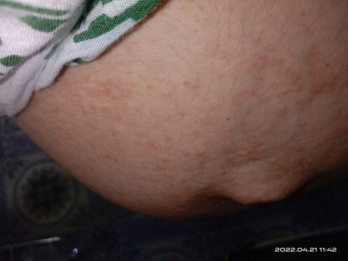 Seluruh badan Gatal2 saat hamil