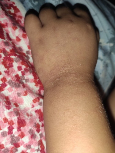 Skin Rashes