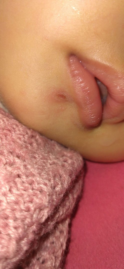 seperti luka dibawah bibir