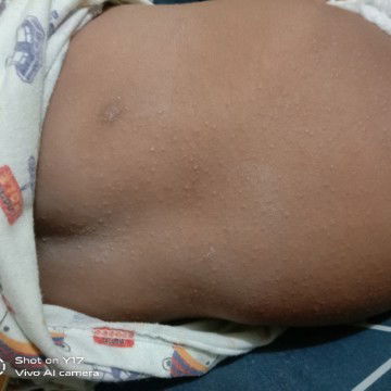 Beruntusan di kulit bayi