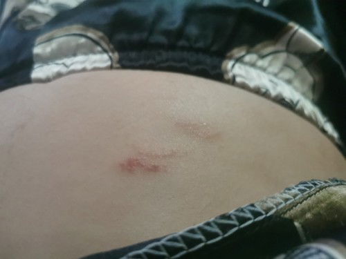 I just want to ask ano pwede ipahid sa skin allergies? Since bata ako I have this seasonal kati-kati