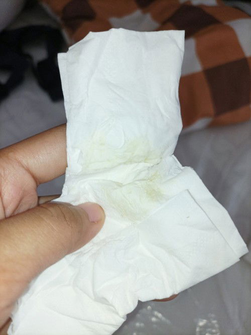 keputihan kuning dan gatal