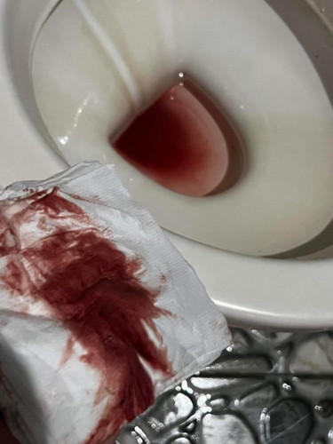 มีเลือดออกเยอะ