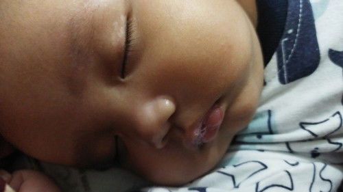 Bercak putih pada kelopak mata bayi