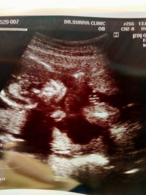 ขอถามแม่หน่อยค่ะว่าในใบอัลตร้าซาวด์นี้ได้เพศหญิงหรือเพศชายคะ (ลุงหมอว่าได้เพศหญิง)
ขอบคุณล่วงหน้าค่ะ