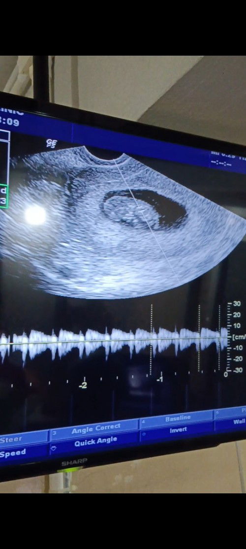 หลังจากสอบถามเลือดออกตอนท้อง