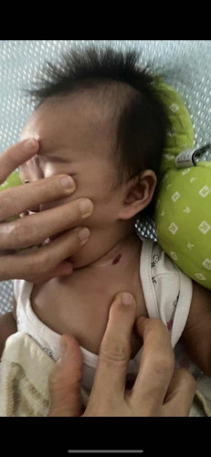 Strawberry birthmark