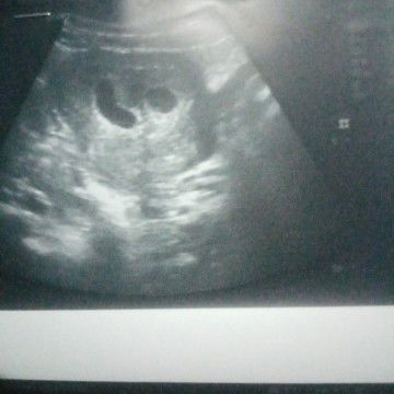 ตั้งครรภ์​แฝด