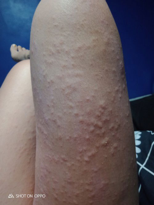 ผื่นคันตอนตั้งครรภ์