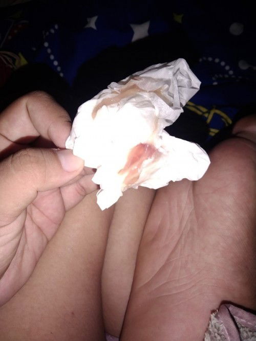 มีมูกเลือดออกหลังกวาดหมดลูก