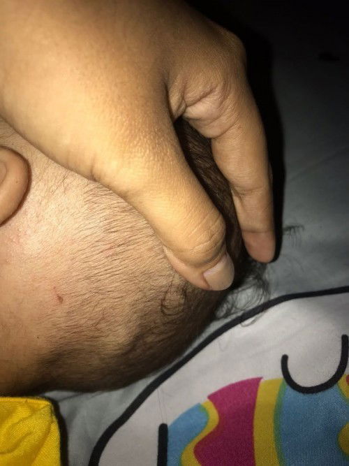 Benjolan kecil di belakang kepala bayi