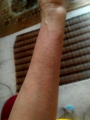 Meroyan kulit