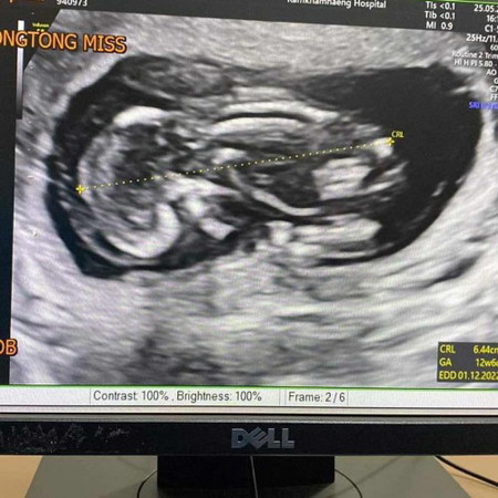 16W6D ขอวิธีทำใจหน่อยค่ะแม่ๆ 😞🙏🏻