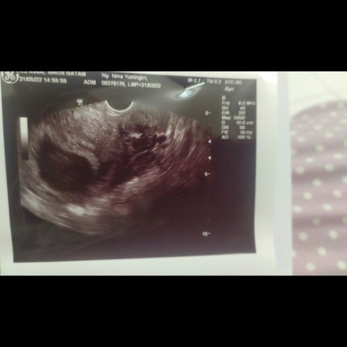 Hamil BO, tunggu atau langsung kuret?