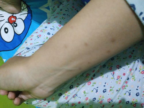 Gatal-gatal saat hamil