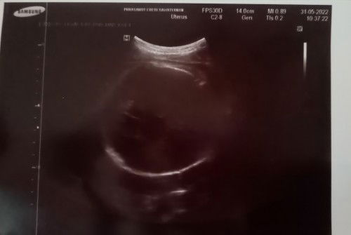 ท้องได้​ 35Week​ 6Day แล้วค่ะ