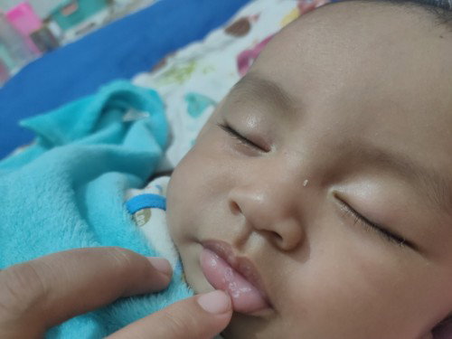 bibir bayi putih
